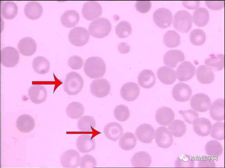 图4箭头所示为两个靶形红细胞(瑞姬氏染色 ×1000)心得体会地中海贫血