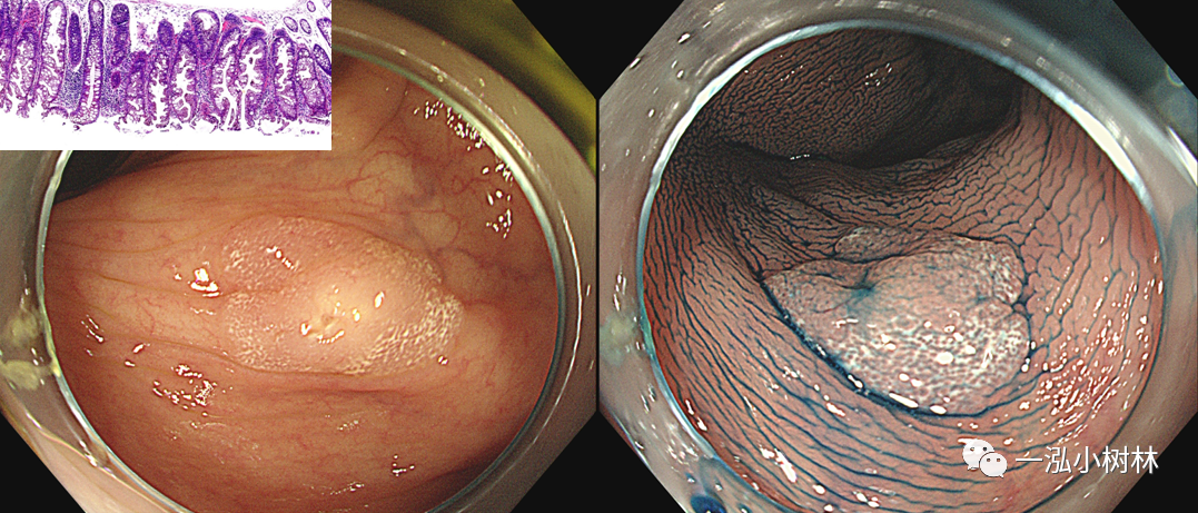 无蒂锯齿状腺瘤病理图谱_医学界-助力医生临床决策和职业成长
