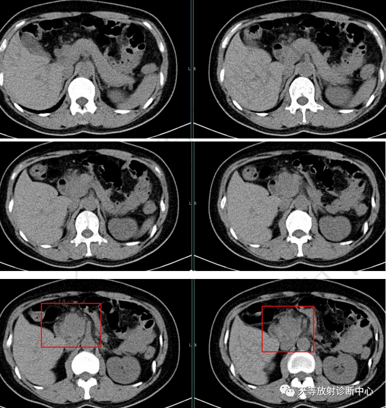 罕见病:胰腺腺泡细胞癌_医学界-助力医生临床决策和职业成长