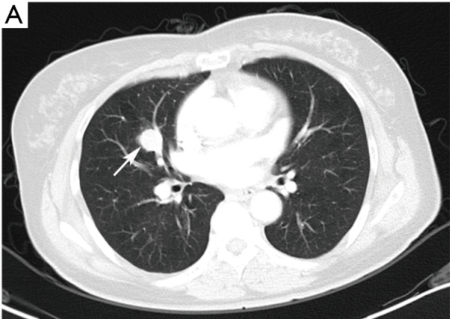 肺活检病理确诊肺癌,手术切下来却是良性肿瘤,是怎么一回事_医学界