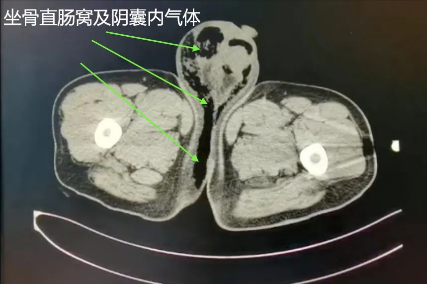 情況↑↑↑4,盆腔ct示:肛周,會陰,陰囊及雙側腹股溝區組織結構紊亂