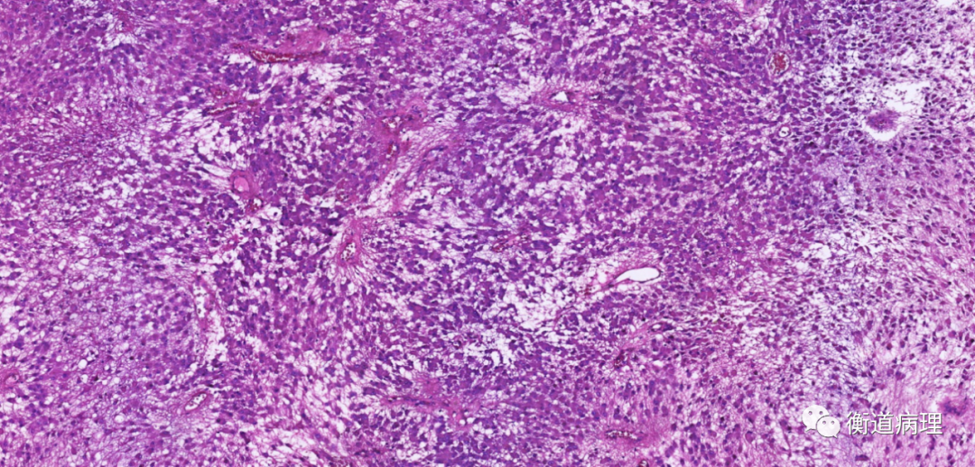 病例讨论儿童脑肿瘤一例