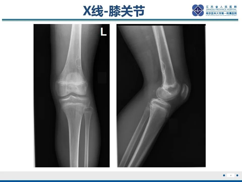 非骨化性纤维瘤CT图片图片