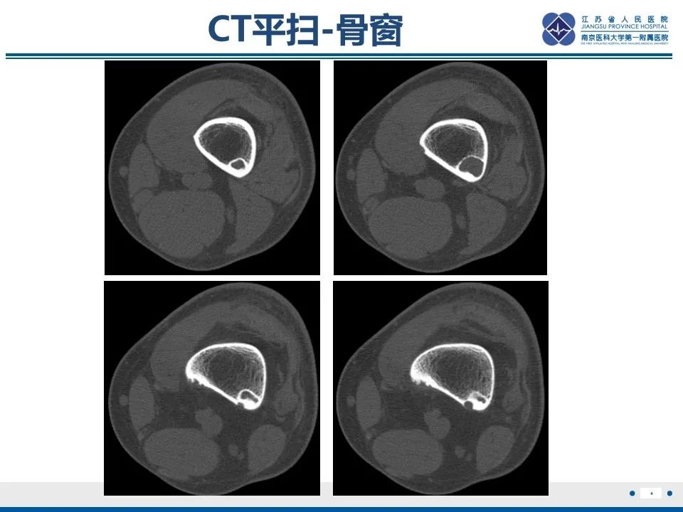 非骨化性纤维瘤CT图片图片