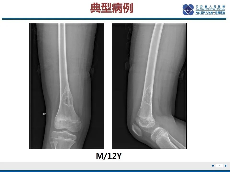 非骨化性纤维瘤 | 影像表现与鉴别