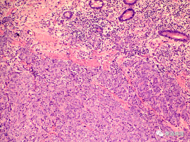 病例分析2*黑色素瘤he形态多样,病理诊断上具有一定的难度与挑战性
