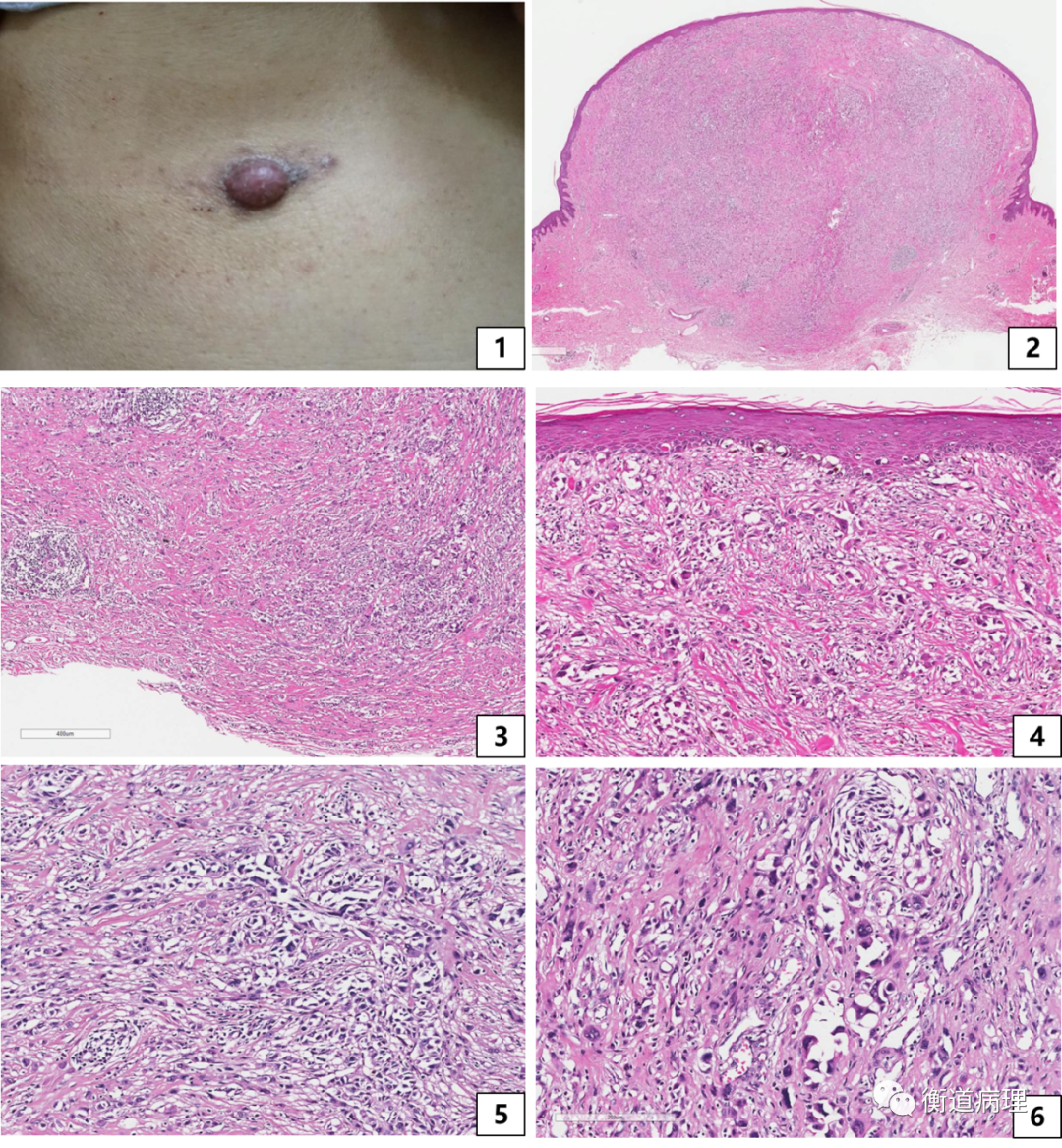 肿瘤细胞排列呈巢状,伴炎症细胞浸润,皮肤基底层有肿瘤细胞佩吉特样