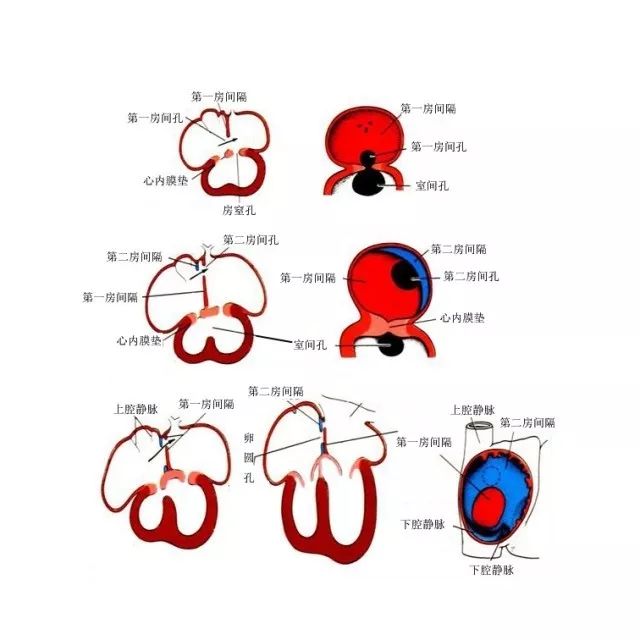 胎儿心内膜垫缺损的超声诊断_医学界-助力医生临床决策和职业成长