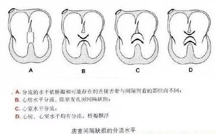 胎儿心内膜垫缺损的超声诊断_医学界-助力医生临床决策和职业成长