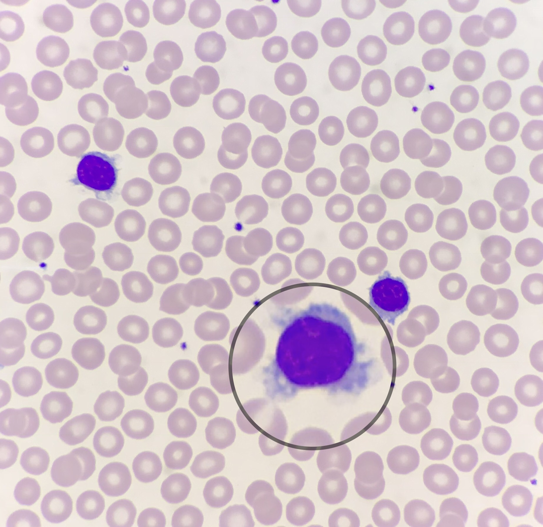 一例由外周血涂片辨识出的毛白_医学界-助力医生临床决策和职业成长