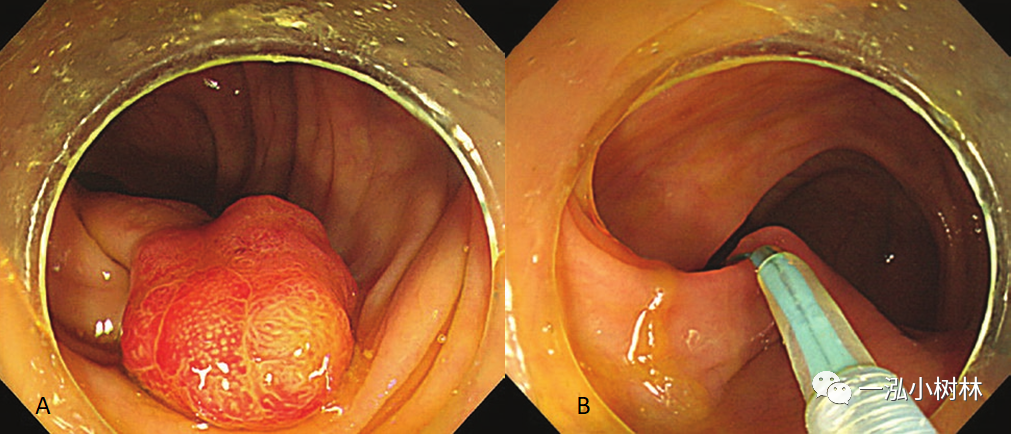 早期结直肠癌的内镜治疗_医学界-助力医生临床决策和职业成长