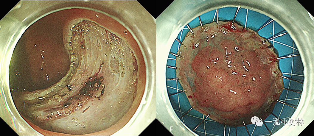 早期结直肠癌的内镜治疗_医学界-助力医生临床决策和职业成长