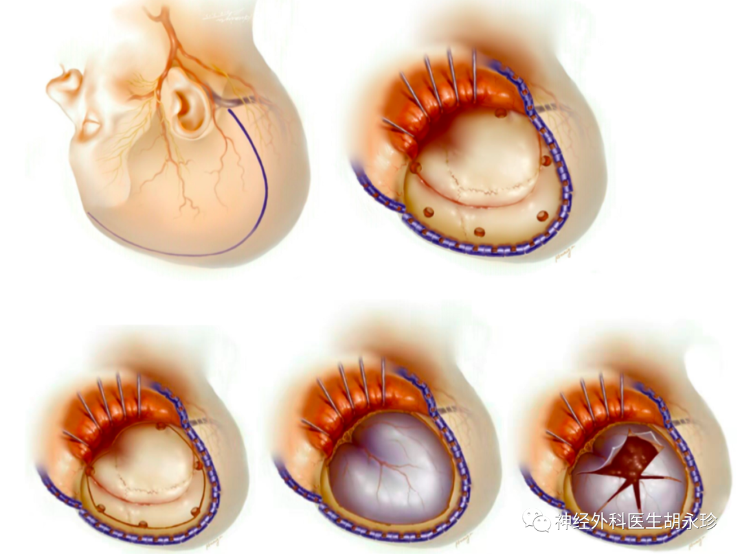经耳后枕顶颞额部超大骨瓣开颅减压术的技术要点