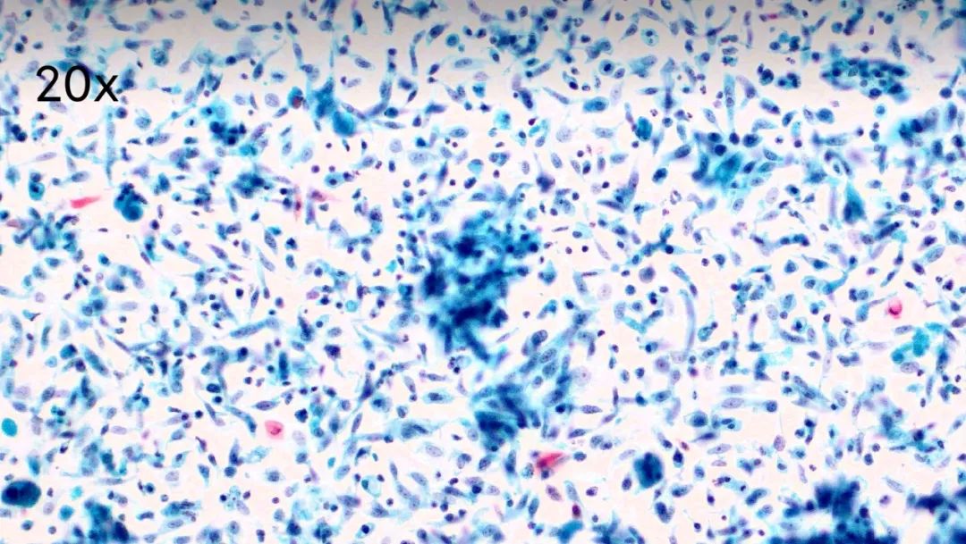 正常情况下已绝经十余年的萎缩宫颈在液基细胞检查中