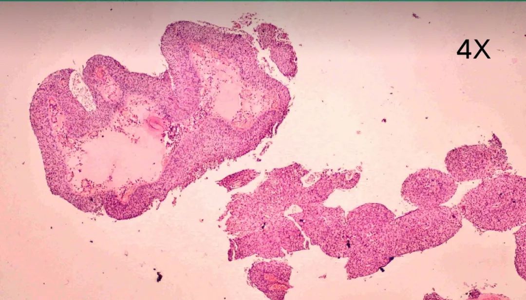 67这样形态的宫颈细胞学检查你的诊断是