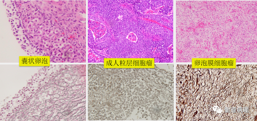 正常囊状滤泡网状纤维染色体会:成人粒层细胞瘤vs卵泡膜细胞瘤2020年