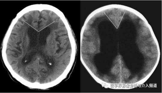 右为脑积水