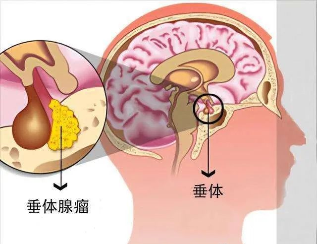 垂体泌乳素腺瘤的治疗