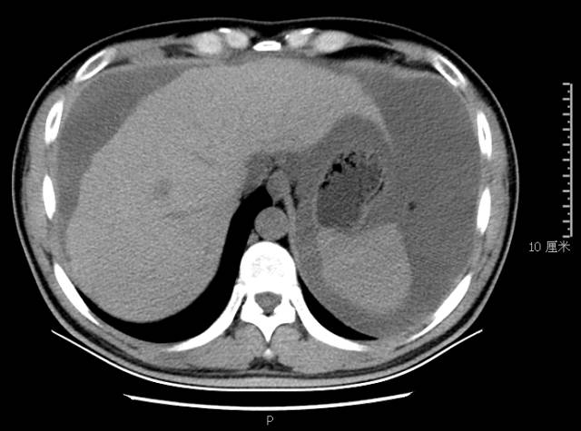 肝脏破裂ct图片图片