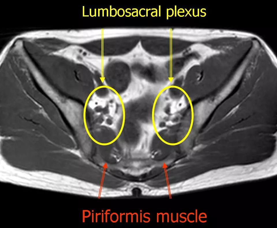 图谱——梨状肌综合征相关mri,纯干货!