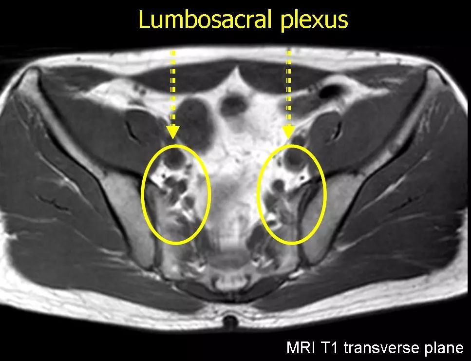 图谱——梨状肌综合征相关mri,纯干货!