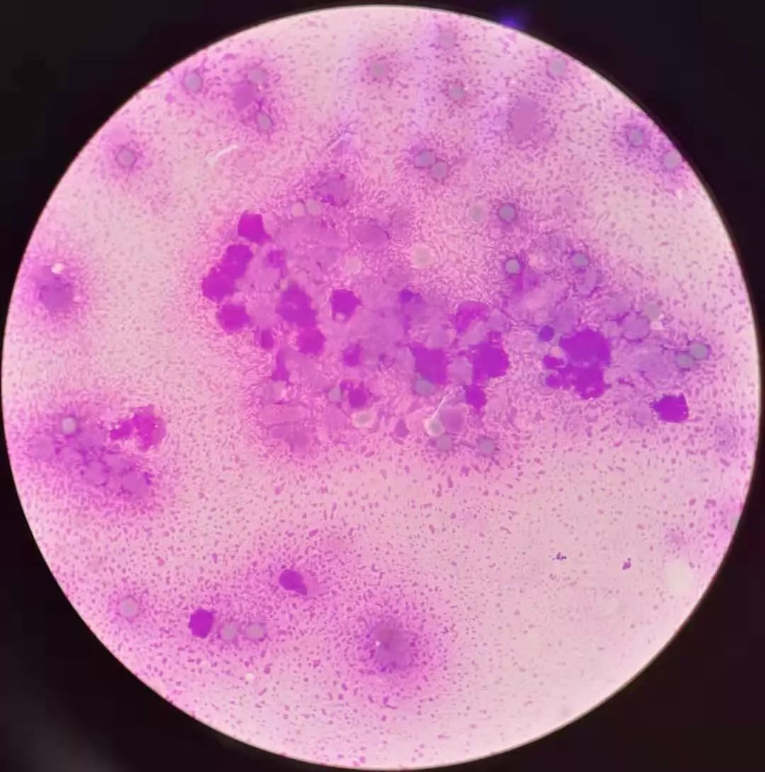 油镜下:低倍镜下:送检骨髓涂片,染色后(中间为正常骨髓涂片,两边为此