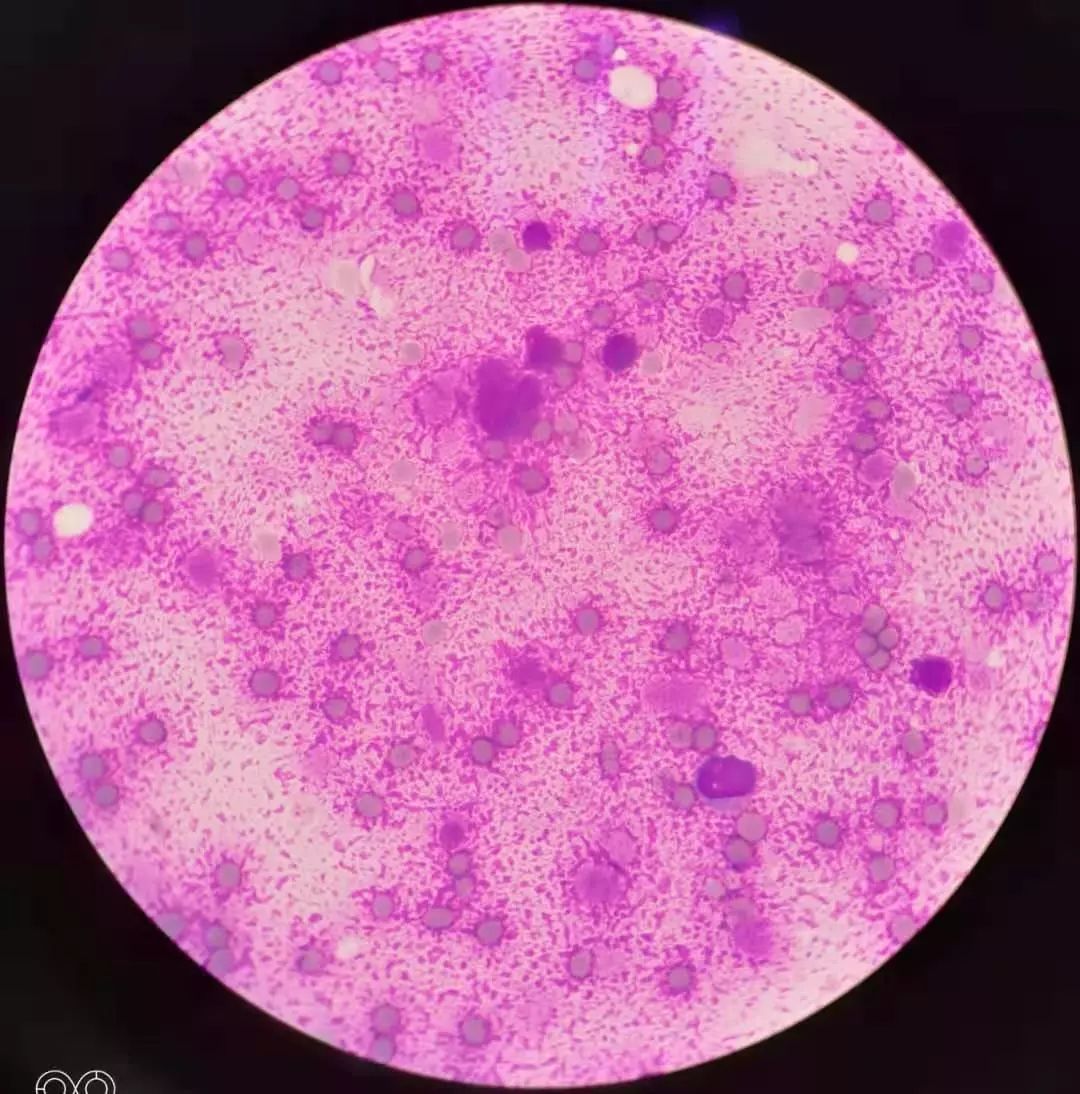 油镜下:低倍镜下:送检骨髓涂片,染色后(中间为正常骨髓涂片,两边为此