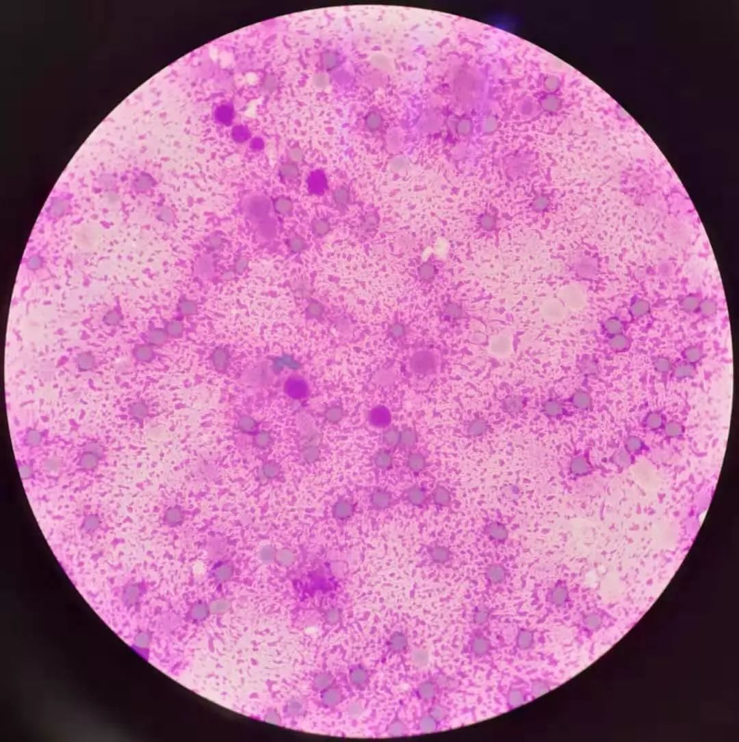 油镜下:低倍镜下:送检骨髓涂片,染色后(中间为正常骨髓涂片,两边为此