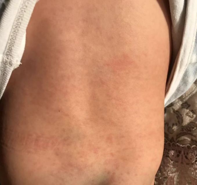 其实这是幼儿急疹,发烧和满身皮疹是同一个病在不同阶段的表现,不是