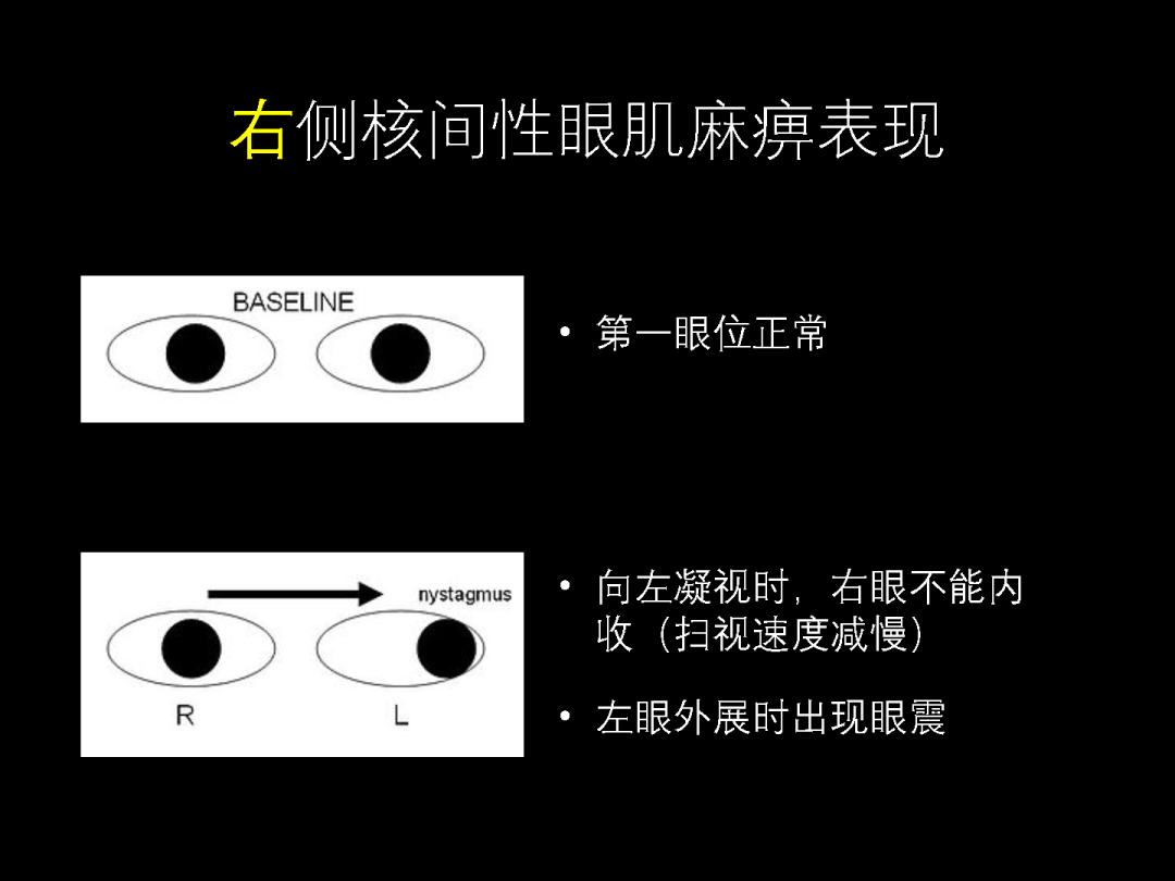 4例不同病因的「复视」,从诊断到治疗,一文搞定!