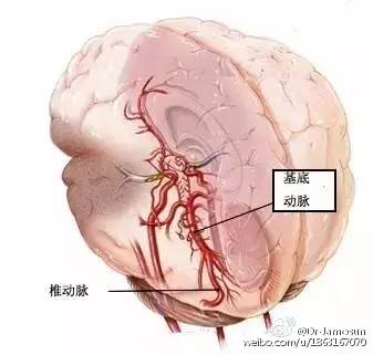 迷路动脉栓塞图片