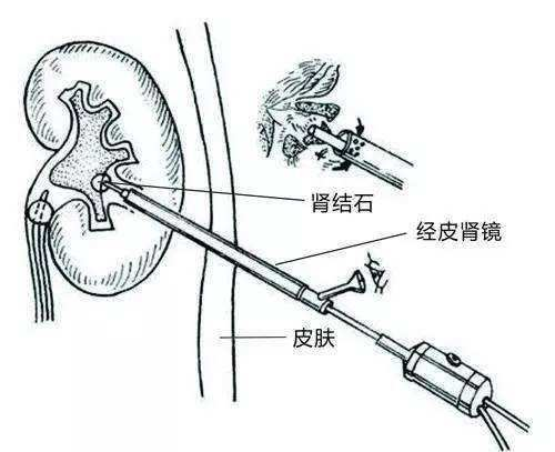 结石小课堂之古龙的七种武器 医学界 助力医生临床决策和职业成长