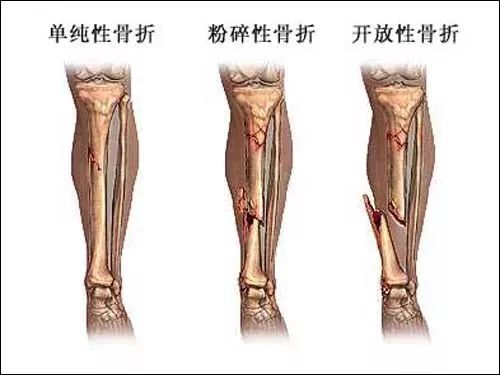 经过良好复位后的外伤性骨折,一般在3～4个月或更长一些时间内,可完全