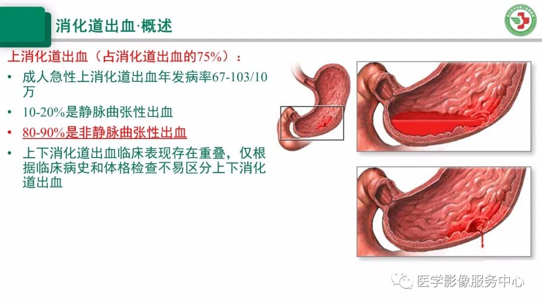 上消化道出血的ct诊断