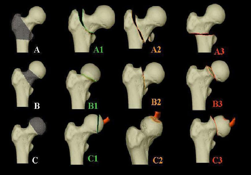 股骨粗隆下骨折分型图片