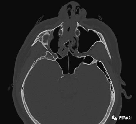 【急诊】颧骨骨折,上颌骨骨折ct表现