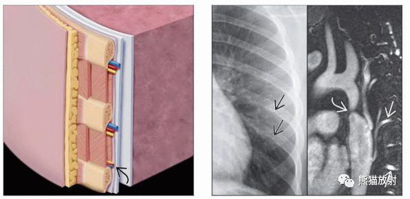 胸壁,横膈解剖及疾病丨图片概述