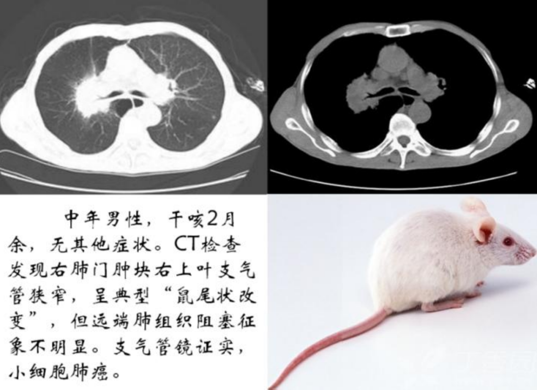 发生在肺癌里的鼠尾征_医学界-助力医生临床决策和职业成长