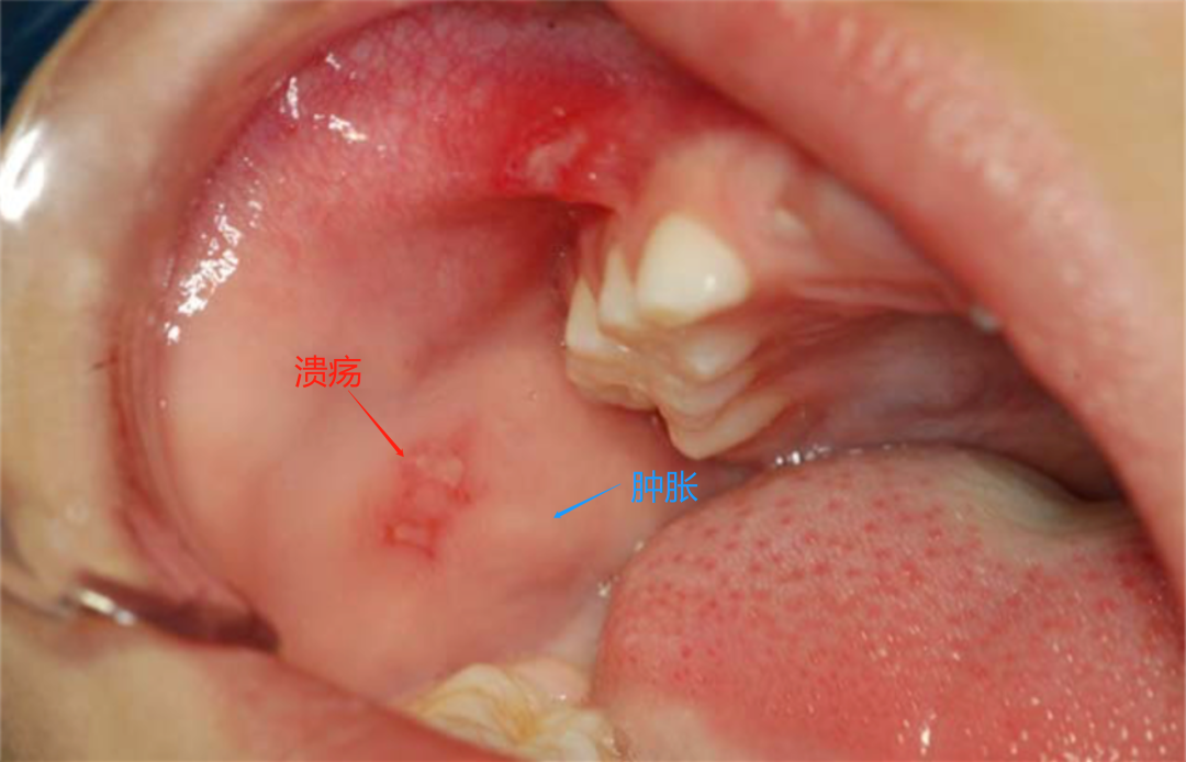 儿童口腔溃疡发病图片图片