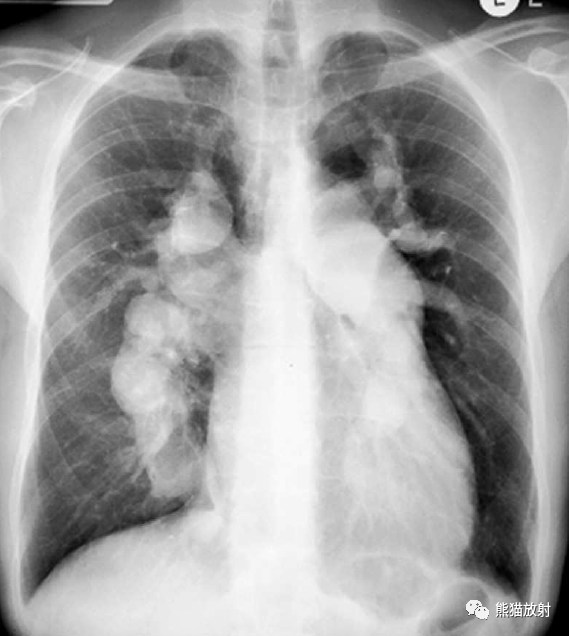 肺动脉高压残根征图片图片