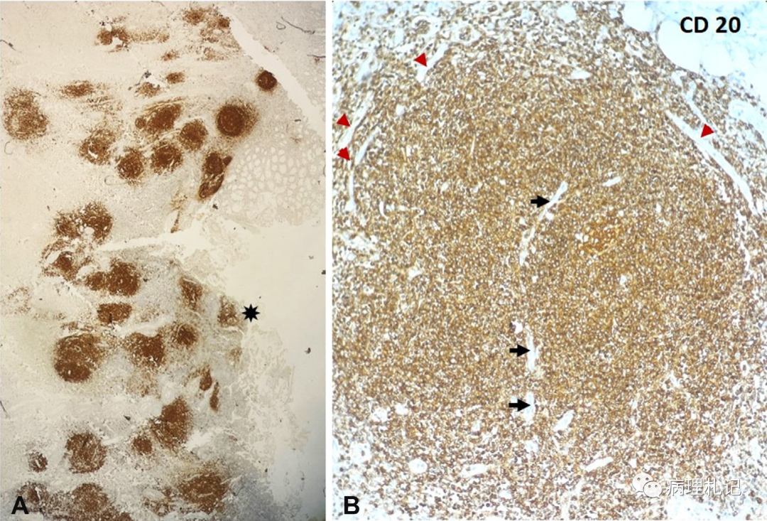病理视角|男性 感染艾滋病毒,锁骨上淋巴结活检