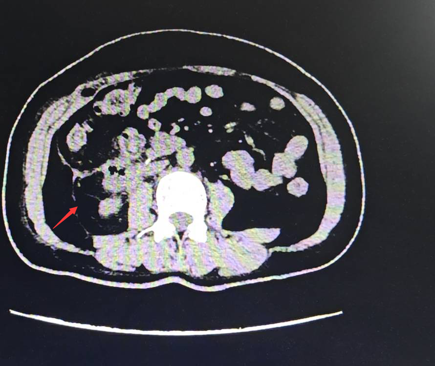 腹膜后平滑肌肉瘤图片