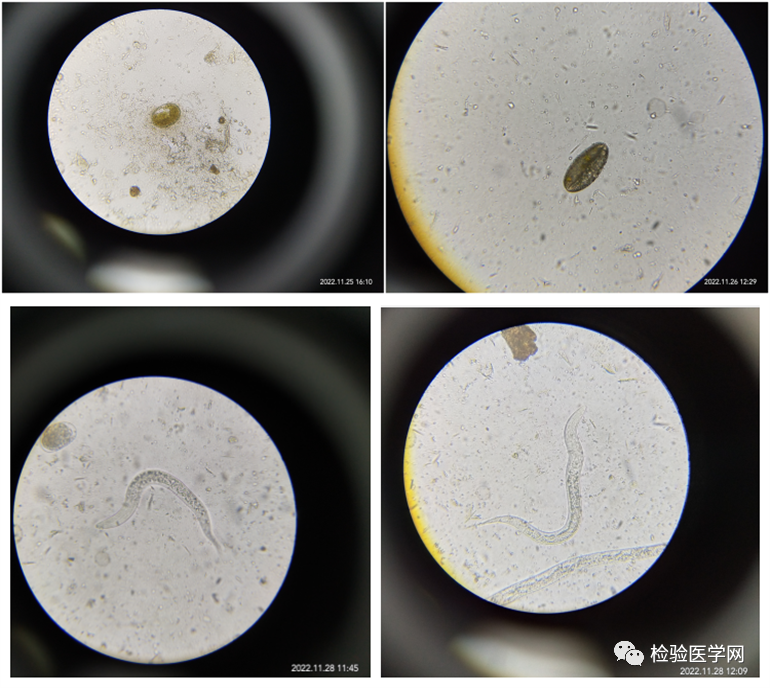 结果:大便常规:棕色软便,隐血阴性,直接涂片可见透明无色,椭圆形,60