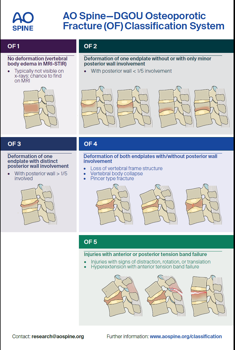 骨质疏松性胸腰椎骨折的ao分型