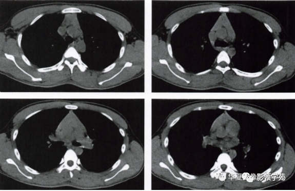 胸腺增生_医学界-助力医生临床决策和职业成长