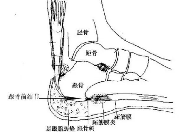 跟骨骨骺约在12~14岁时闭合,主要发病原因也是大量运动导致跟腱点与跟