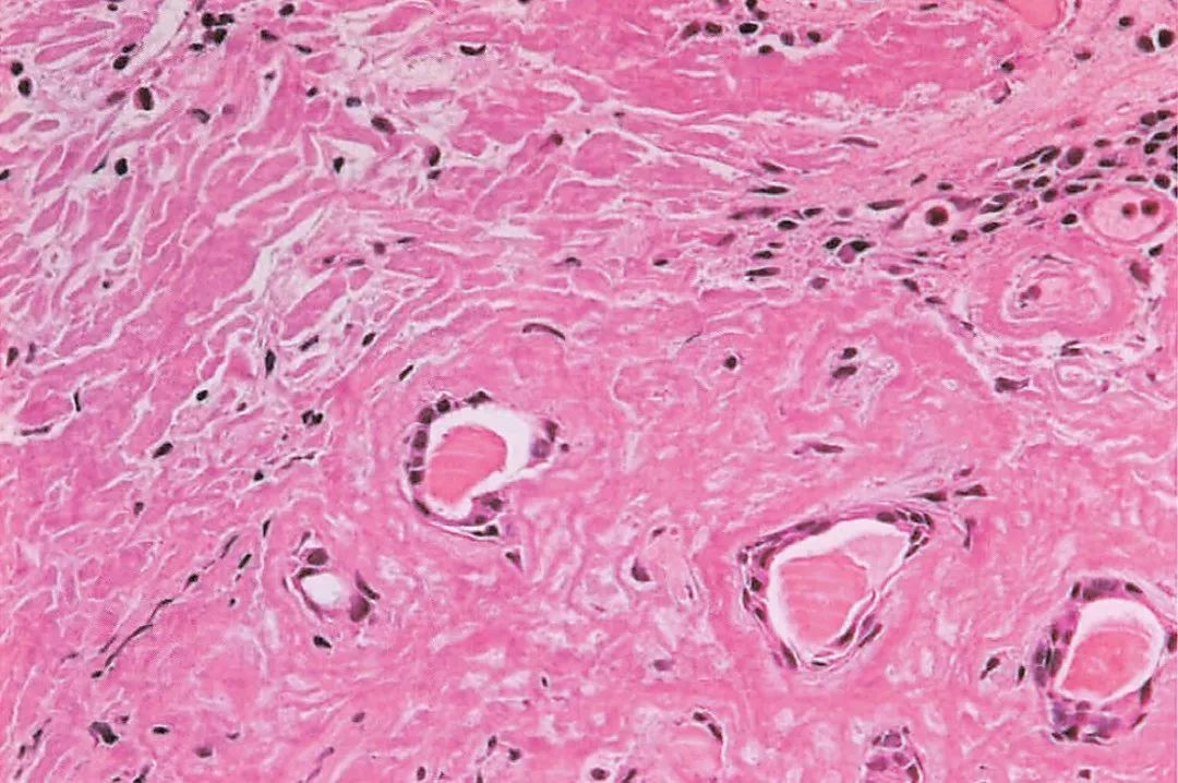 一文理清:【喉淀粉样变】影像诊断与治疗思路!