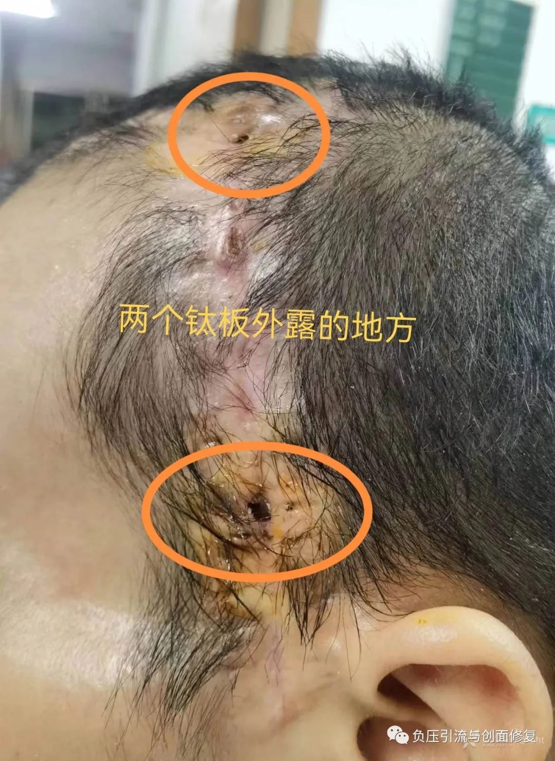 颅脑修复术后切口裂开钛板外露4小时紧急手术修复2周痊愈