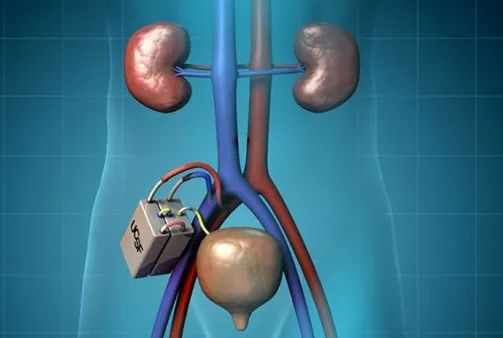 前沿进展:植入式人工肾,动物试验初获成功!