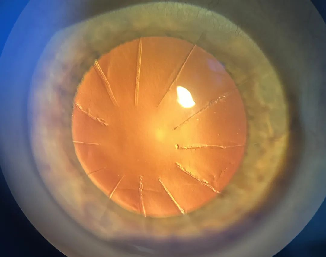 裂隙灯的检查流程和常见眼部问题总结 - 知乎